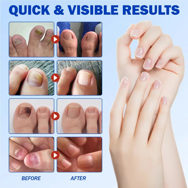 Up to 65% OFF!🔥Nail Health Care Patches – Repair and Strengthen Weak Nails