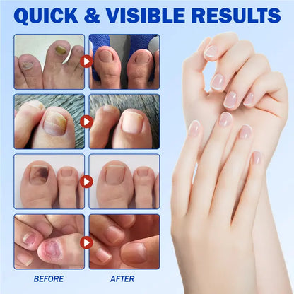 Up to 65% OFF!🔥Nail Health Care Patches – Repair and Strengthen Weak Nails